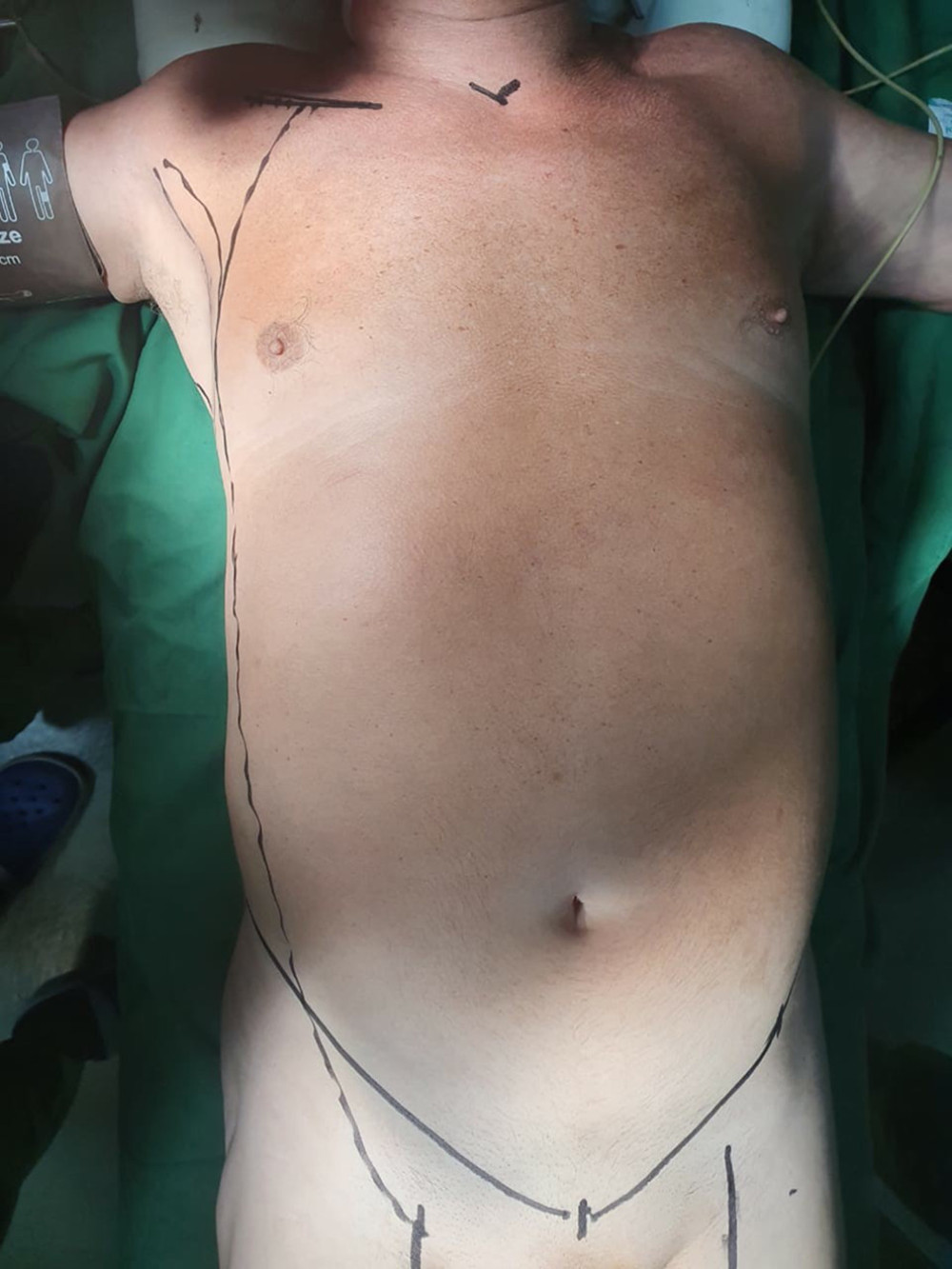 Site marking: one finger below right mid-clavicle for proximal anastomosis, lateral tunneling along midaxillary line, and inguinal for distal anastomosis.
