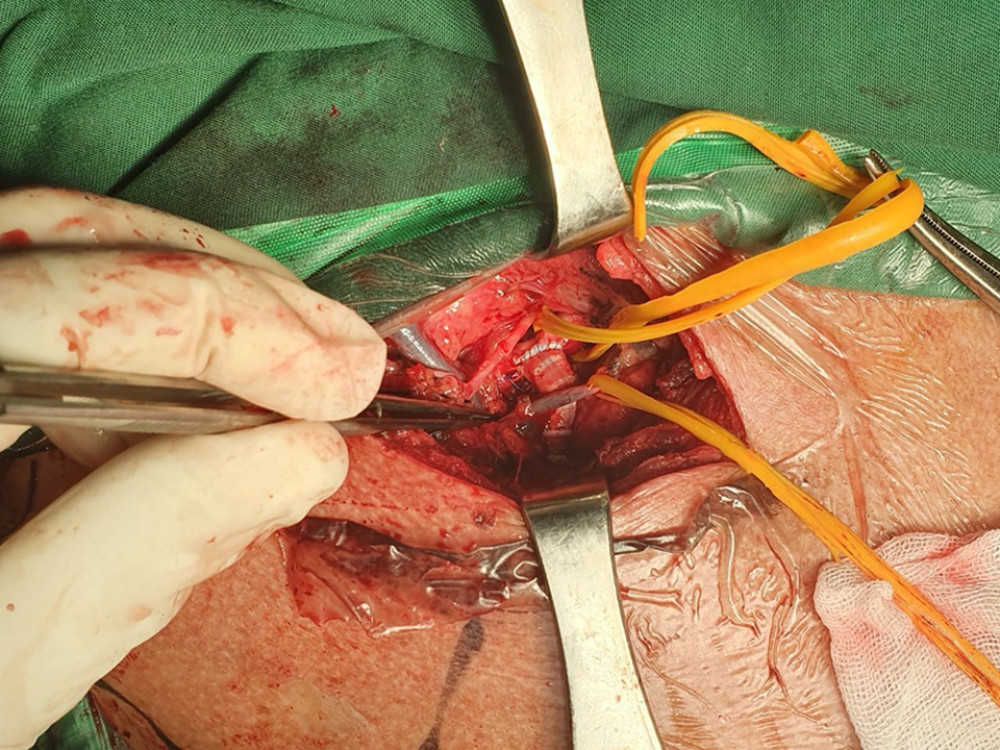Proximal anastomosis of the right subclavian artery with 5/0 monofilament nonabsorbable suture. The PTFE graft was passed under the subclavian vein to avoid compression.