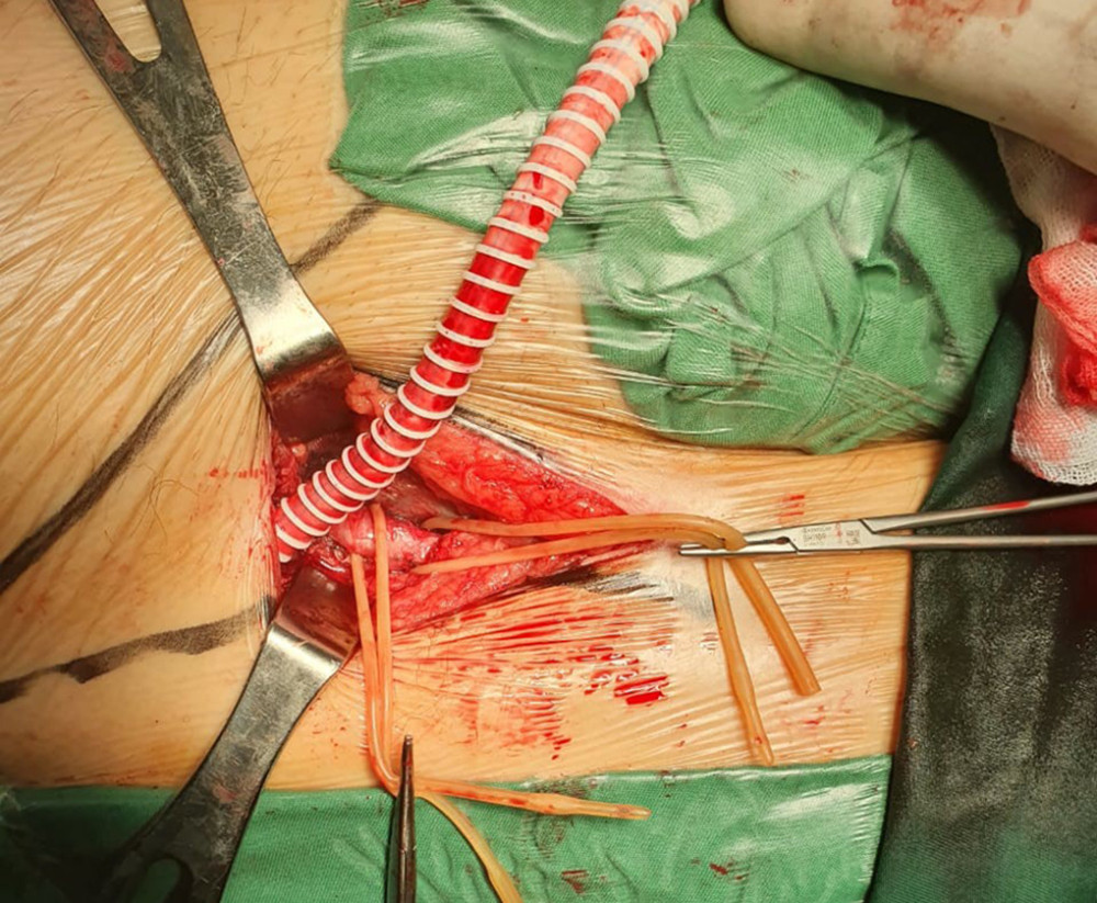 A 7-mm, non-kinked PTFE graft was tunneled along the mid-clavicle, midaxillary line to right inguinal, then anastomosis to common femoral artery.