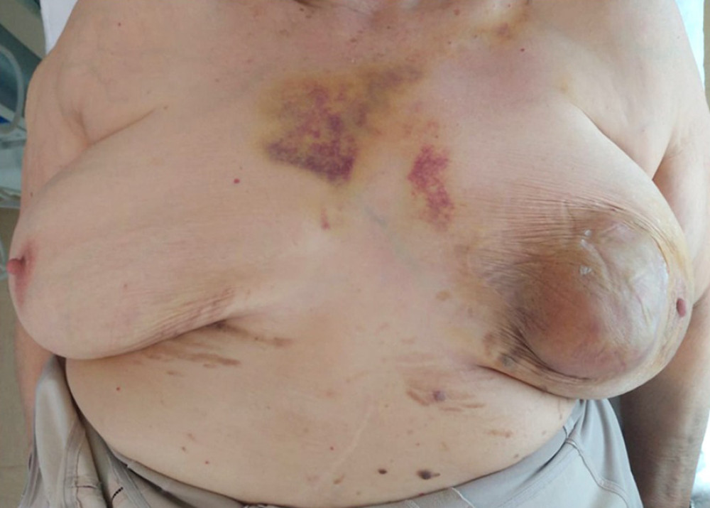 Huge palpable mass in the upper inner quadrant of the left breast. The size of the mass was gradually increasing.