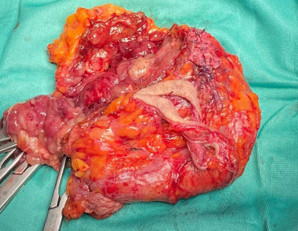 En bloc resection of mass was completed.