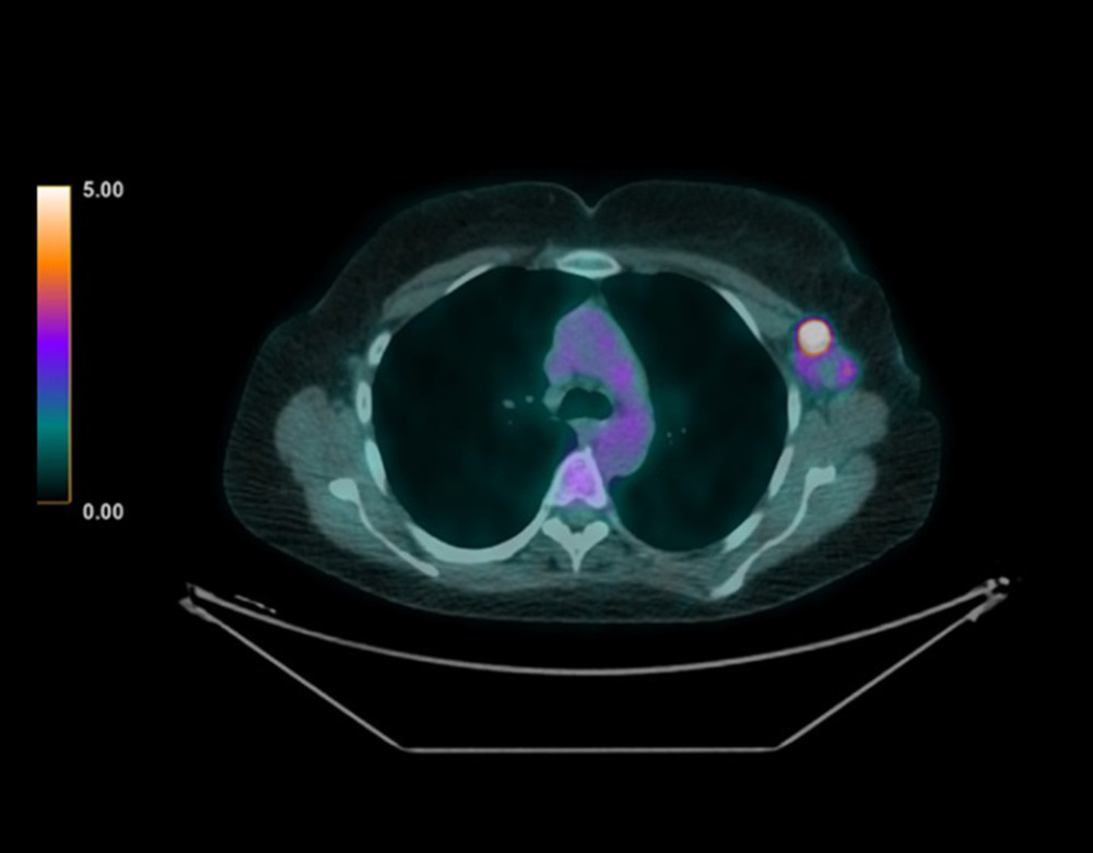 Axial image of PET/TC scan showing an intense hypermetabolism enhancement in left axilla.