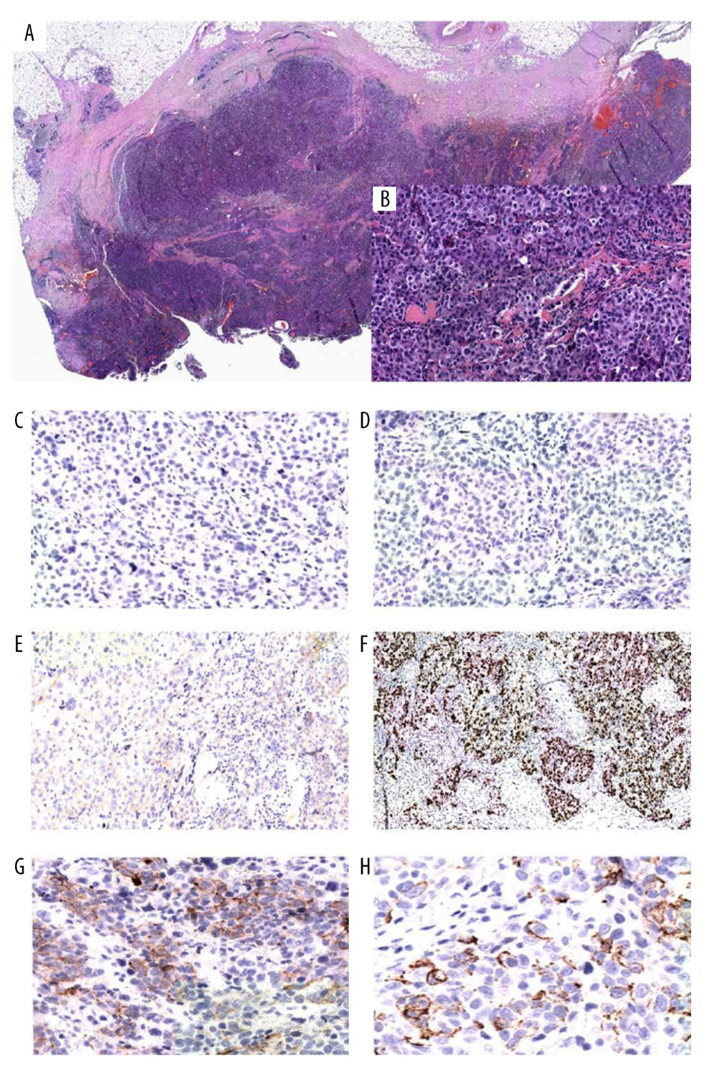Histopathological features of the described tumor. The histological diagnosis was NST invasive breast cancer with a cystic wall, poorly-differentiated, of grade 3 (G3), as observed by hematoxylin and eosin staining at magnification ×1 (A) and ×20 (B). Immunohistochemical features of ER (C), PR (D), and HER2 (E) at magnification ×20. ER, PR, and HER2 staining results were all negative. The Ki-67 labeling index was 80% (F) at magnification ×20. The result of staining with basal cytokeratins, CK 5/6 (G), and CK14 (H) was focally positive at magnification ×20.
