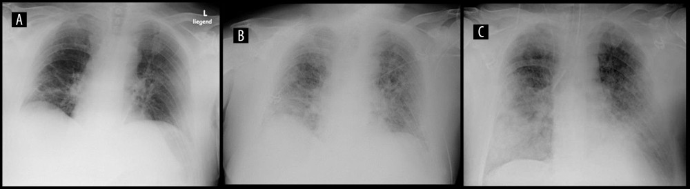 Supine chest x-ray on days 1 (A), 3 (B), and 7 (C) showing progressive bilateral infiltrates, predominant basal distribution, and development of fibrosing alveolitis.