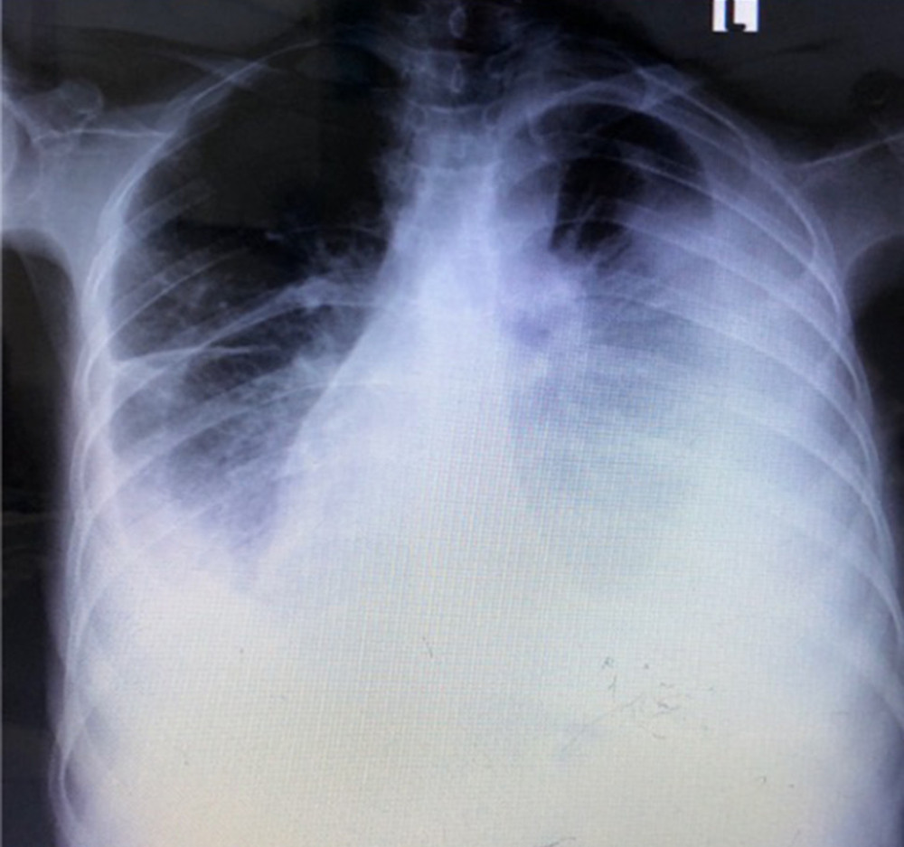 Chest X-ray at the one-year follow-up showed bilateral pleural effusion.