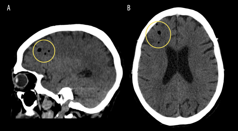 (A) Sagittal and (B) axial nonenhanced computed tomography scan performed the day of admission shows multiple foci of gas in the subarachnoid spaces of the right frontal lobe (yellow circles).