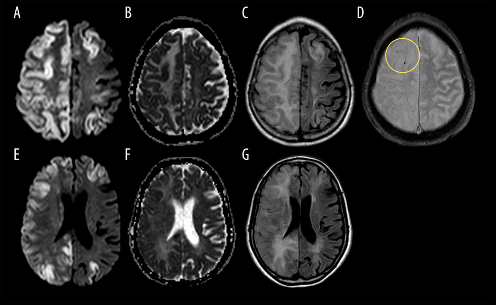 Nonenhanced brain magnetic resonance imagining performed 1 day after admission. Axial (A, E) diffusion-weighted imaging (DWI) and (B, F) apparent diffusion coefficient (ADC) show gyriform cortical restricted diffusion throughout the frontal and parietal lobes (more extensive along the right hemisphere), with corresponding (C, G) fluid-attenuated inversion-recovery (FLAIR) hyperintense edema. (D) Axial susceptibility-weighted imaging (SWI) shows small foci of susceptibility artifact at the right frontal lobe, correlating with air emboli; better visualized on previous head CT.