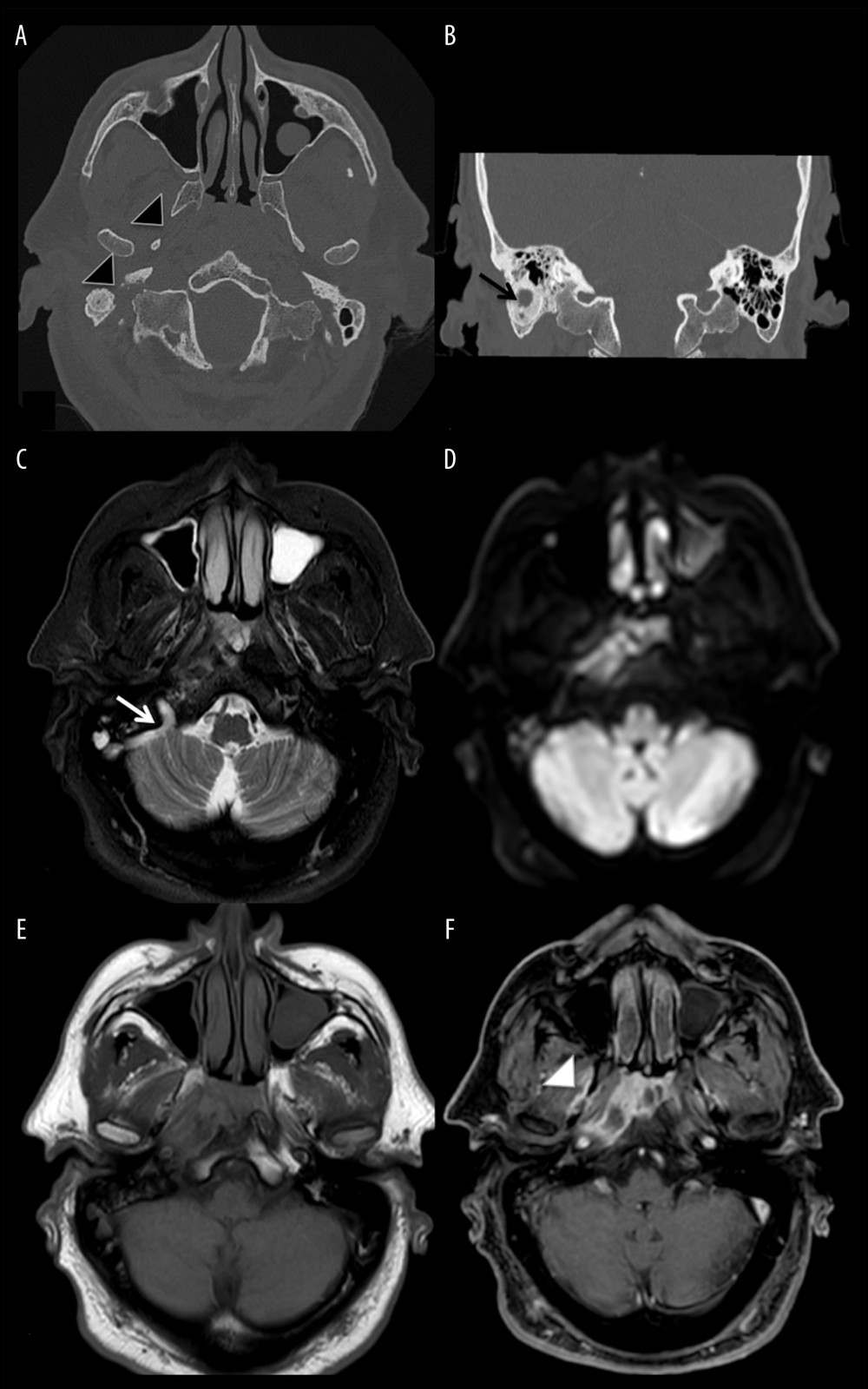 Case 1 – Imaging of the petrous bone in a patient with right external necrotizing otitis extended to the skull base: axial and coronal unenhanced CT scan (A, B) showed asymmetric nasopharynx air lumen due to prominent soft tissue swelling on the right side, with opacification of the mastoid air cells; extensive erosive phenomena of the petrous bone and the pterygoid process were also visible (black arrowheads) along with areas of osteitic thickening of the mastoid (black arrow); axial unenhanced (C–E) and contrast-enhanced MRI (F) showed a large area of altered signal within the right temporal bone extending from pharyngeal mucosal space, para-pharyngeal space and retro-pharyngeal space to external auditory canal and retrocondylar fat tissue, with restricted diffusion and inhomogeneous post-contrast enhancement involving pterygoid muscles (white arrowhead) as well as tensor and elevator muscles of the palatine veil. Local nerves and vascular structures were also involved, with mild reduction of the intra-petrous internal carotid artery flow signal and jugular bulb/upper internal jugular vein obliteration with slow flow in the sigmoid sinus (white arrow), probably due to external compression by the surrounding tissues.