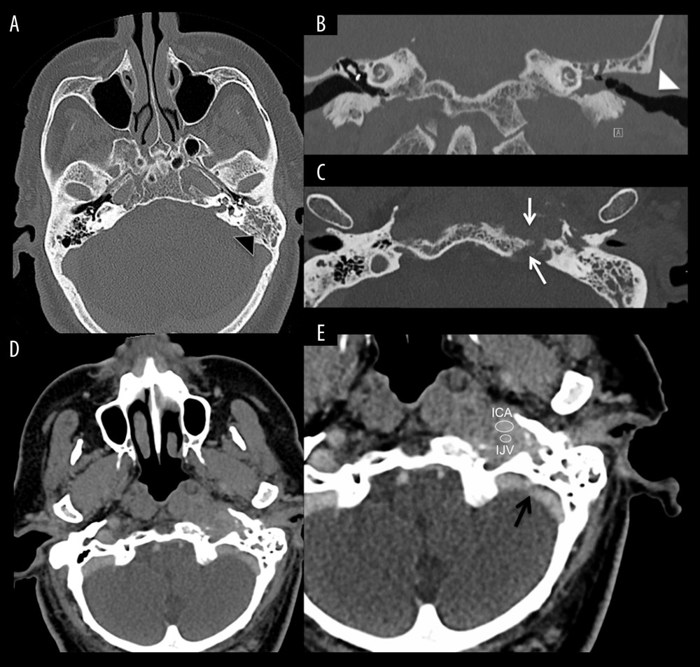 Case 2 – Imaging of the petrous bone in a patient with left malignant otitis externa: axial and multi-planar reformations of unenhanced CT scan with bone reconstruction algorithm (A–C) showed secondary opacification of the left mastoid air cells compared to the normally aerated right side (A: black arrowhead), stenosing soft tissue thickening of the external auditory canal (B: white arrowhead) with focal bony erosion of the inferior wall and extensive erosive phenomena of the temporal bone as well as the adjacent clivus (C: white arrow). Contrast-enhanced CT scan with soft tissue reconstruction algorithm of the petrous bone (D, E) showed asymmetrical swelling of the oropharynx with areas of diffuse contrast uptake extending to retropharyngeal, para-pharyngeal and carotid space on the left side. Carotid space vessels were displaced (E: white circle); lumen reduction due to external compression without thrombosis of the internal jugular vein was present, with normal opacification of the transverse and sigmoid sinus above (E: black arrow).