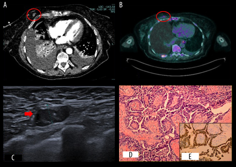 (A) Tumor lesion of the right breast (CT-scan; red circle). (B) Hypermetabolic tumor lesion of the right breast (PET scan; red circle). (C) Well-circumscribed, nodular, hypoechogenic breast lesion (Ultrasound; red arrow). (D) Massive infiltration of tumor cells with papillary structures and necrosis (histology; hematoxylin and eosin stain, 100×). (E) Diffuse and strong nuclear staining ofPAX 8 in tumor cells (immunohistochemistry; 200×).