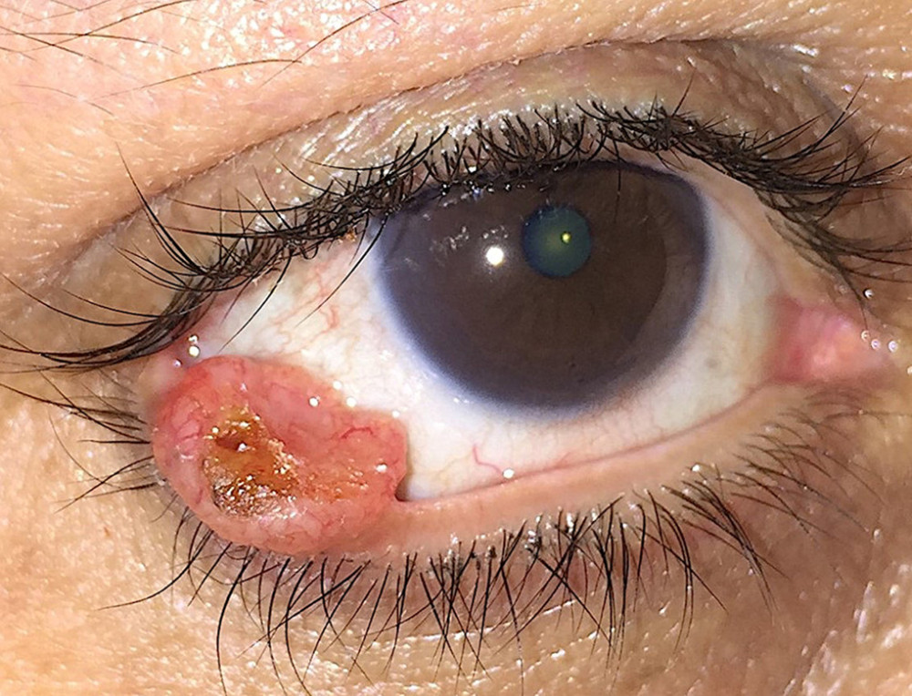 A cauliflower-like pearly telangiectatic lesion arising from the posterior lamella at the eyelid margin with central ulceration. Note the preservation of lashes and the normal appearance of the surrounding tissues.