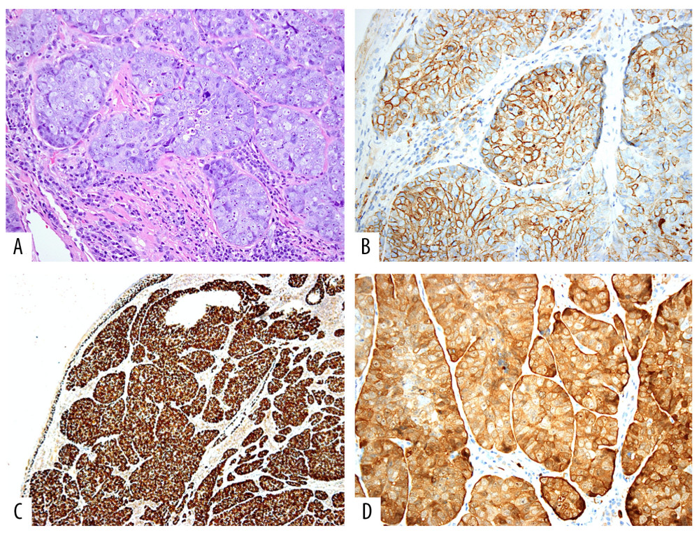 (A) Histopathologic appearance of the proliferating sebaceous-looking cells in a lobular pattern within the subepithelial stroma (original magnification ×200, hematoxylin and eosin). (B) The tumor cells reacting to epithelial membrane antigen (original magnification ×200). (C) Lower power showing the nuclear staining of SGC cells using p63 immunohistochemistry marker (original magnification ×50). (D) The SGC tumor cells reacting to p16 (original magnification ×200).