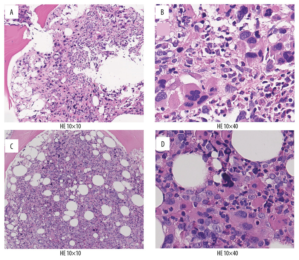 Bone marrow histology showing severe fibrosis with large and clustering megakaryocytes at the first (A, B) and second (C, D) admissions.