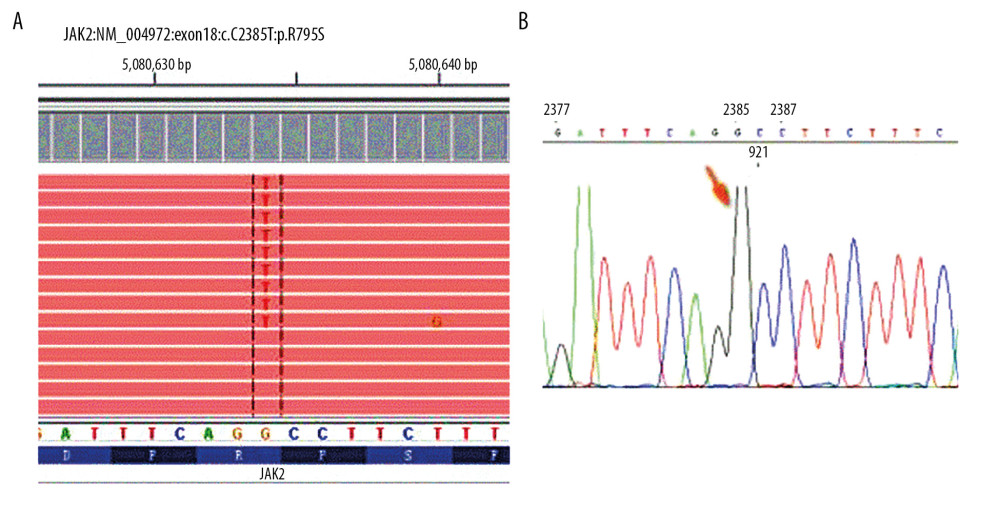 Molecular findings before the first round of induction chemotherapy with modified IA. (A) Next-generation sequencing showing a JAK2 gene mutation in exon 18 (c. 2385 G >T: p.R795S). (B) Sanger sequencing showing the absence of the JAK2 R795S gene mutation in hair and nails of the same patient.