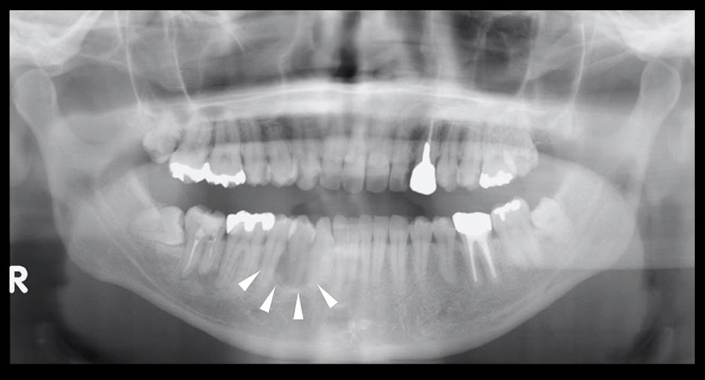 Panoramic radiograph at the first visit. Arrowheads indicate the unilocular, radiolucent, lesion with a well-defined border.