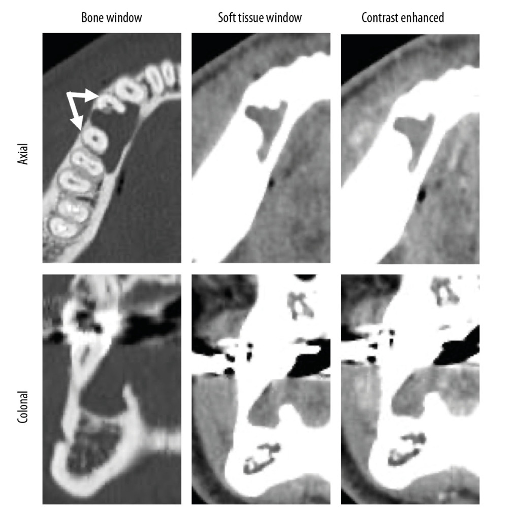 Bone window, soft tissue window, and contrast-enhanced computed tomography at the first visit. Arrows indicate root separation of the first and second premolars, and root resorption of the first premolar.
