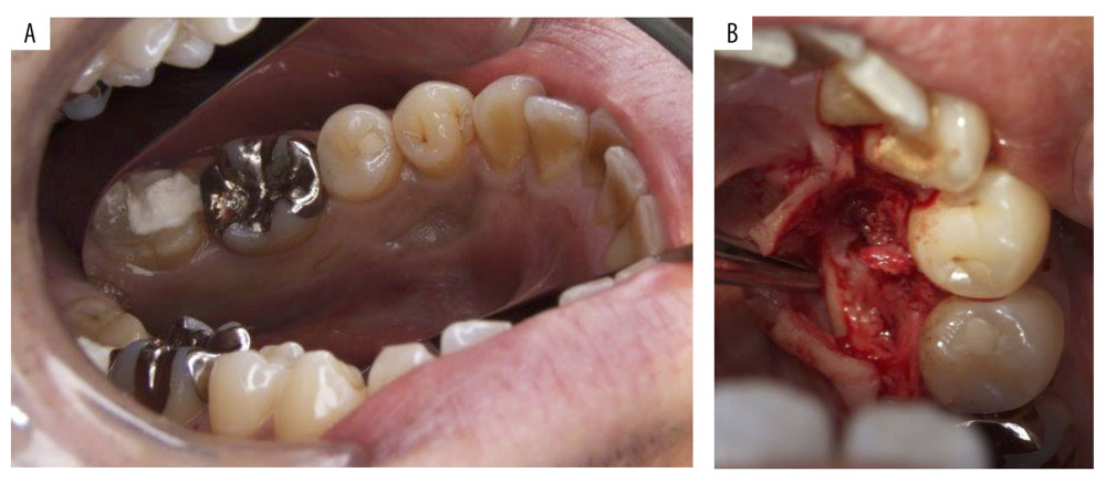 (A) Oral photograph before the biopsy. (B) Raising of the mucoperiosteal flap and exposure of the tumor.