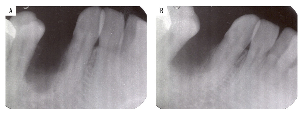 (A) Dental radiographs taken 2.5 months after the enucleation. (B) Five months after the enucleation. New bone formation in the bone defect was evident.