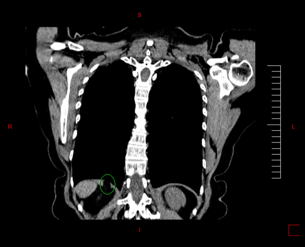 CT scan coronal section showing diaphragmatic lipoma marked with a green circle.