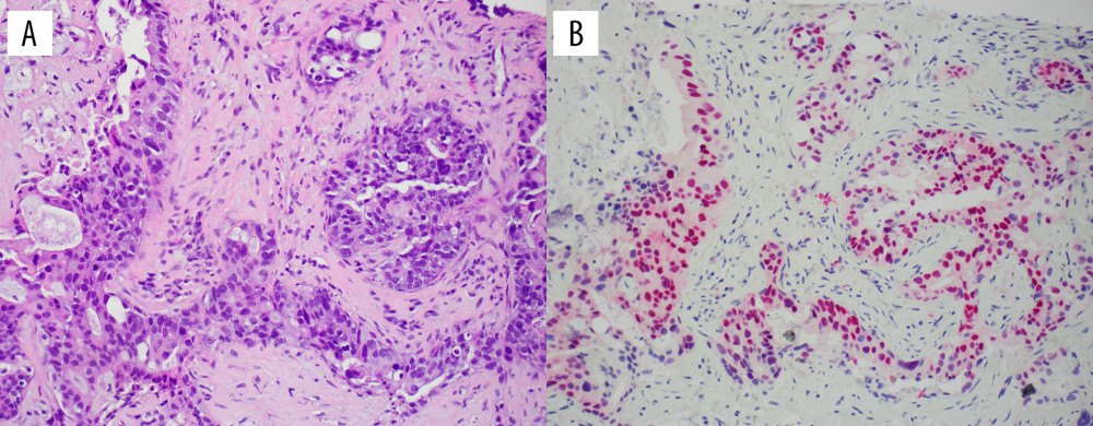 (A) Hematoxylin and eosin staining (20×) of salivary duct carcinoma showing ducts with cribriform pattern in a background of fibrosis. The tumor cells are markedly pleomorphic with ample eosinophilic cytoplasm. (B) Androgen receptor immunohistochemical staining with red chromogen (20×) of salivary duct carcinoma showing immunoreactivity.