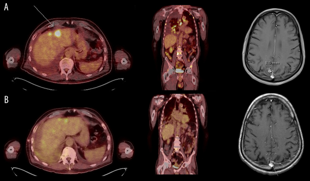 (A) Pretreatment PET/CT and brain MRI showing pleural effusion, mediastinal adenopathy, and bony, liver, and cerebellar metastases. (B) PET/CT after 6 months of treatment showing good partial response to treatment with near resolution of pleural effusion, chest adenopathy, and bony metastases with shrinking of cerebellar metastasis.