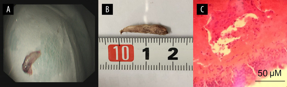 Morphologic observation of the suspected parasite. (A) One of the foreign bodies was removed by gastroscopy; (B) After fixation with alcohol, the suspected parasite was brown and woody, and approximately 1.8 cm in length; (C) The histologic section shows that there was no tegument characteristic of flatworms on the outer edge of the specimen, and there was blood and inflammatory exudates in the inner part.