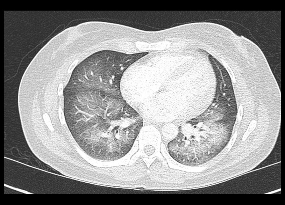 CT angiogram demonstrating symmetrical patchy ground-glass opacification, attributed to diffuse alveolar hemorrhage in this specific clinical context.