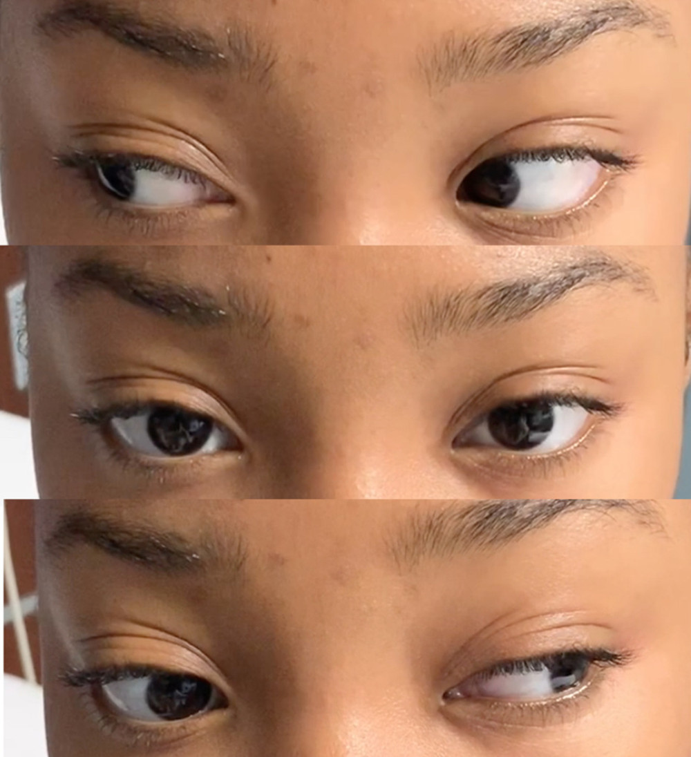 Extraocular movements in right, primary and left gaze. Note the limitation in adduction of the right eye. There is an associated contralateral nystagmus of the left eye with attempted left gaze.