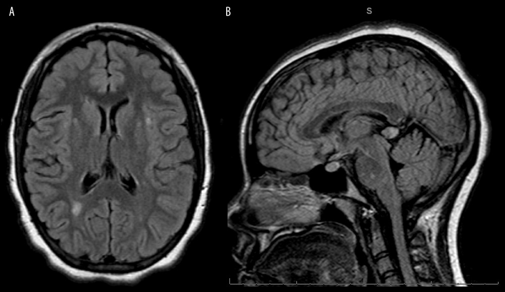 Magnetic resonance imaging of the head using T2/FLAIR sequencing. (A) Scattered bilateral foci of periventricular and subcortical deep white matter. An axial section demonstrating an active demyelinating lesion of the left and posterior right cortical regions. (B) Sagittal image of foci of abnormal signal within in the pons. Of note, there is an incidental benign cystic enlargement of the pineal gland.