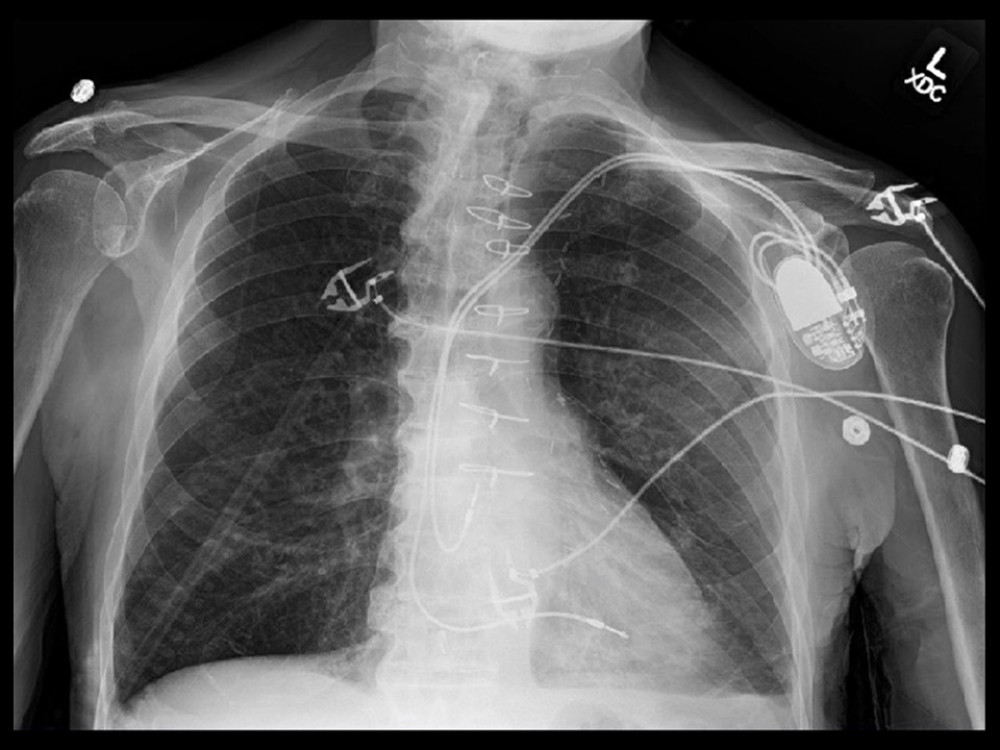 Posteroanterior view of the patient’s chest showing the blunting of the left lateral costophrenic angle.