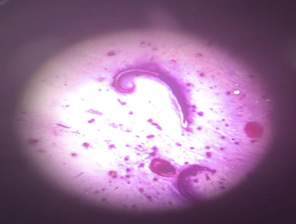 Bronchial lavage examination and gram stain showing larva of Strongyloides stercoralis (original magnification, ×100).