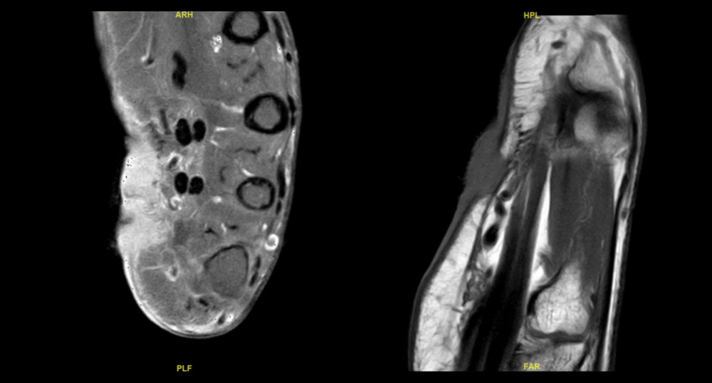 MRI of the hand demonstrating the eccrine tumor involving the skin and extending into the subcutaneous tissue with stranding and abnormal areas of signal extending to the level of underlying tendons.