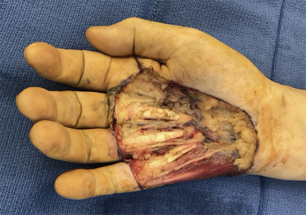 Final excision with 1–2 cm margins preserving underlying tendons and neurovascular bundles.