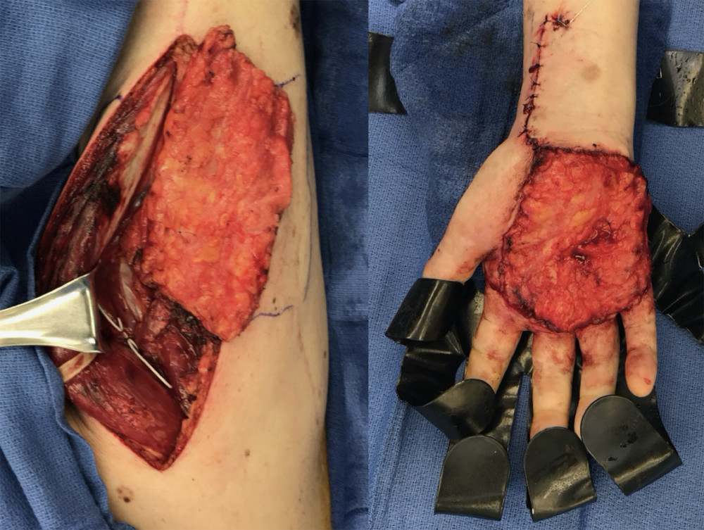 Right anterolateral thigh fascia perforator flap with inflow from the transverse branch of the lateral circumflex artery anastomosed to the radial artery.