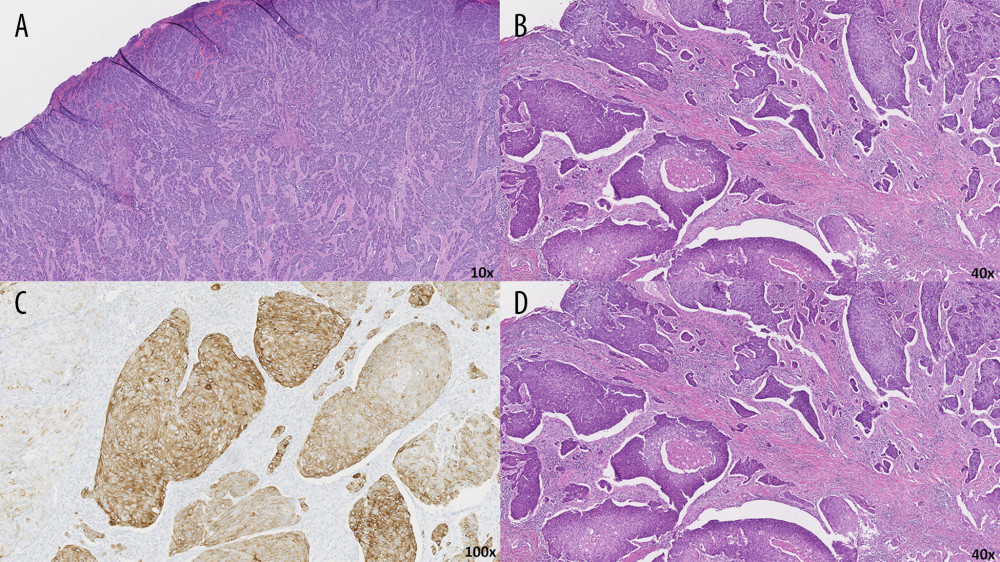 (A) H+E staining demonstrating porocarcinoma with nests and islands of tumor cells with irregular anastomosing cords. (B) H+E staining with increased mitotic activity with areas of necrosis. (C) Immunohistochemical staining of CK7. (D) Immunohistochemical staining of CK5/6.