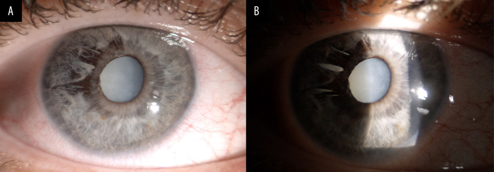 (A, B) Preoperative right eye (RE): superotemporal iridoschisis – “shredded” appearance of the iris and mature cataract.