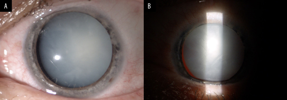 (A, B) Preoperative left eye (LE): mydriasis, mature cataract, temporal lens subluxation.