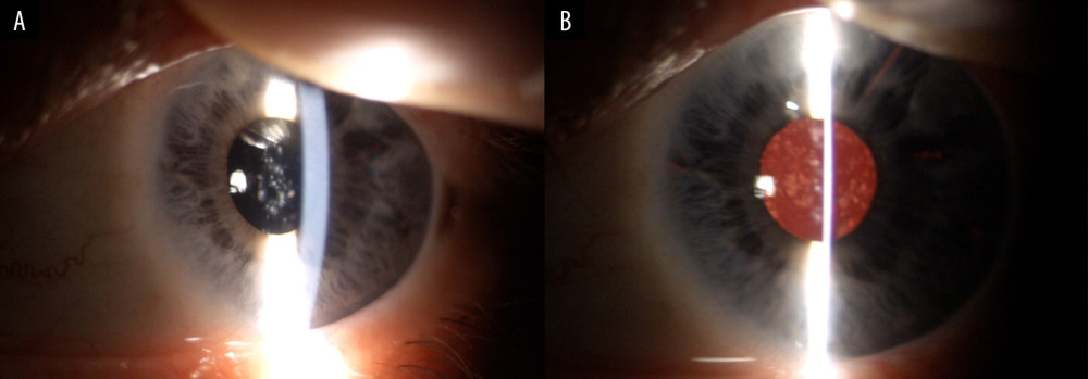 (A, B) Postoperative left eye (LE): superotemporal iridoschisis and round residual inflammatory deposits on the iris-claw lens surface.