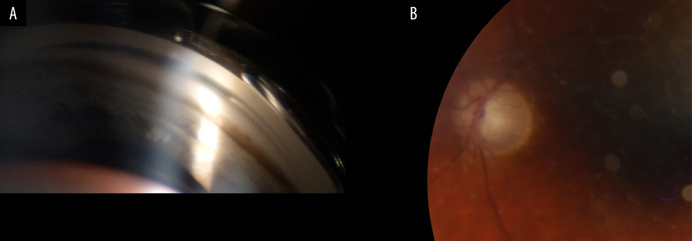 (A) Postoperative left eye (LE): gonioscopic view of open angle, excess trabecular meshwork pigmentation. (B) Optic nerve head: advanced glaucomatous optic neuropathy, c/d=0.9.