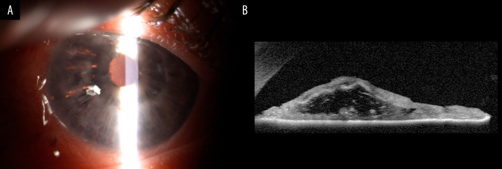 (A) Postoperative right eye (RE): superotemporal iridoschisis, quiet anterior chamber and intrascleral sutureless intraocular lens fixation. (B) Anterior segment optical coherence tomography of the right eye (RE) showing disorganization of the iris stroma – iridoschisis.