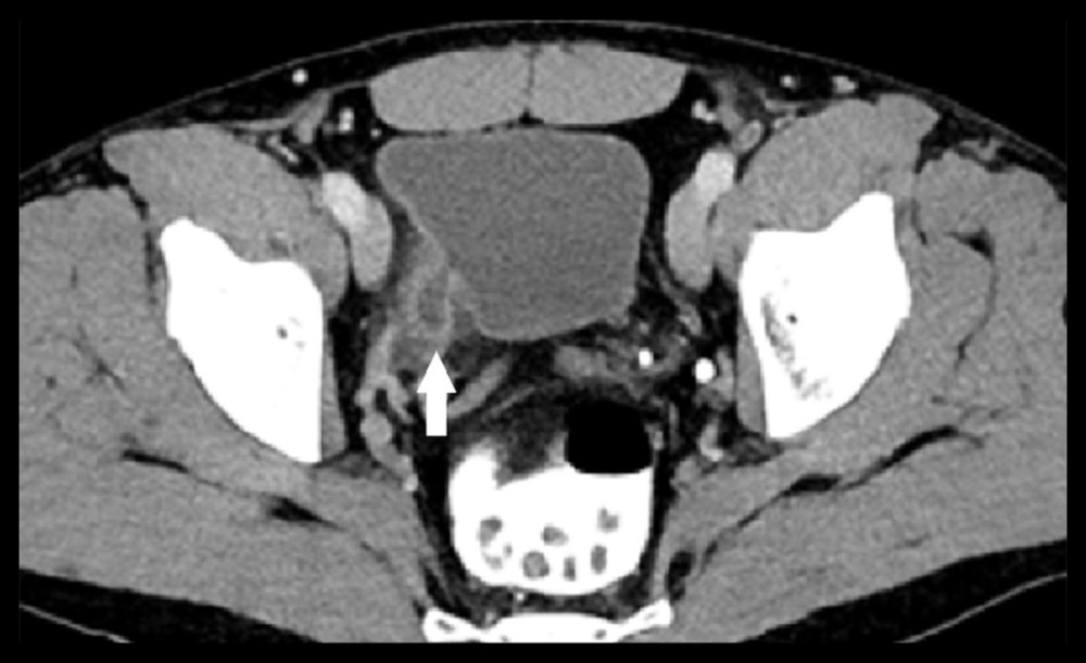 CT scan (axial image) with intravenous contrast Omnipaque 350 (80 mL) shows focal outpouching of the right posterolateral bladder wall in keeping with a diverticulum (white arrow). Another smaller diverticulum is seen in the left posterolateral wall (white arrow head). Around the larger diverticulum, there is fat stranding. The diverticulum wall is thickened with increased enhancement and fuzziness compared with the rest of bladder wall, in keeping with acute transmural inflammatory changes.