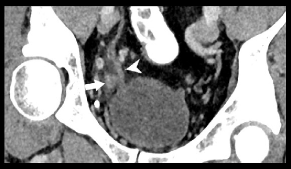 Coronal oblique reconstruction shows the inflamed bladder diverticulum (white arrow) in close relation to the right distal ureter. There is mild thickening of the ureteric wall (white arrow head).