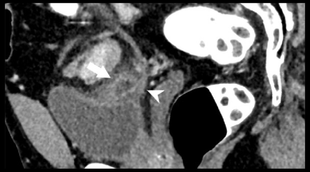 Sagittal oblique CT image shows the inflamed bladder diverticulum (white arrow) in close proximity to the right distal ureter (white arrow head), which may account for increased red blood cells in the urine as the surrounding fat stranding involves the right distal ureteric fat. The distal ureteric wall is thickened and enhancing.