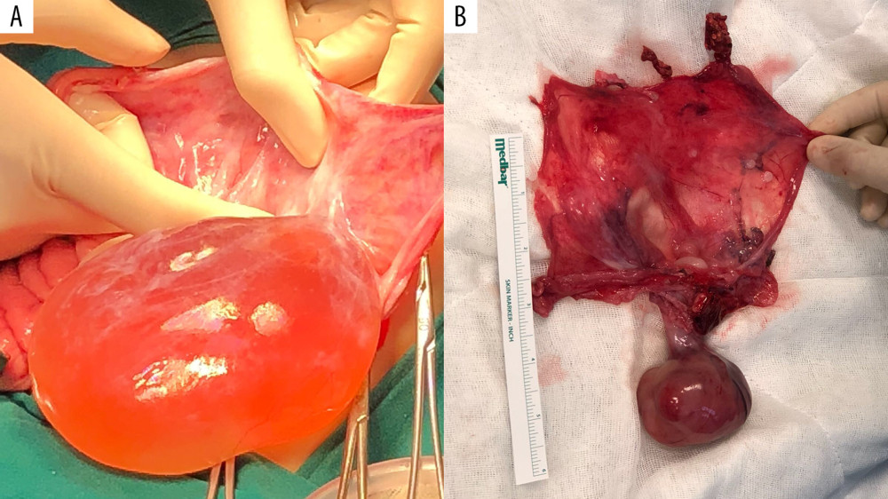 During laparotomy, a clear serous fluid-filled intact sac with a solid component was detected (A). The spleen and pancreas appeared normal and were easily detached from the cyst sac. The left adrenal gland was removed as it could not be detached from the wall of the cyst. The wall of the cyst was cut open exposing the solid component connected to the wall of the cyst with a stalk. A homogenous, smooth, ovoid shaped rubbery solid component connected to the cyst wall with a 2.5-cm stalk was removed (B).