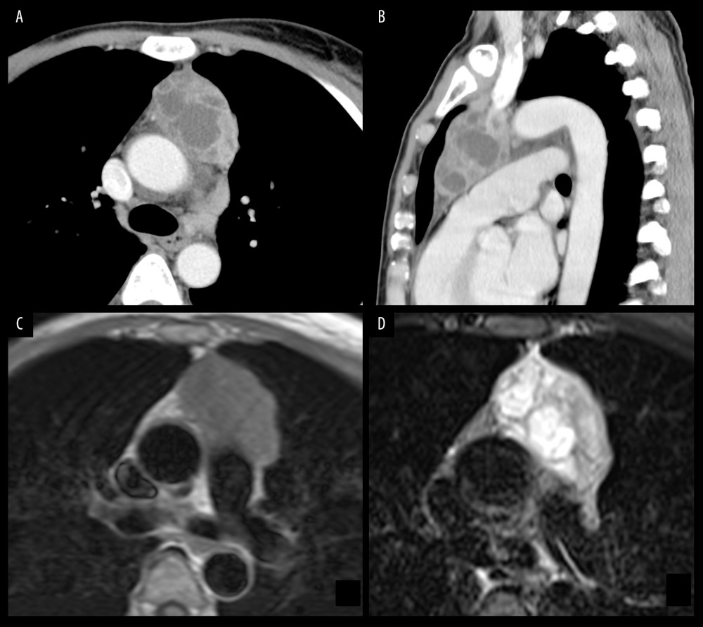 Case 1. Enhanced computed tomography images (A, B) and magnetic resonance imaging (C, D) show a cystic mediastinal tumor. The T2-weighted image (D) shows thick-walled internal septa that contain fluid.