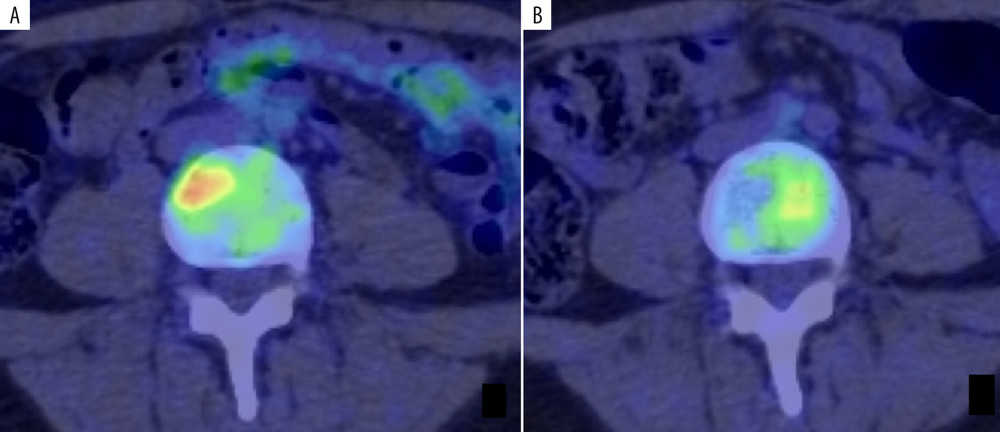 Positron emission tomography-computed tomography (PET-CT) of case 1. [18F] 2-Fluoro-2deoxy-D-glucose accumulation that was visible on PET-CT before the treatment (A) had disappeared (B).