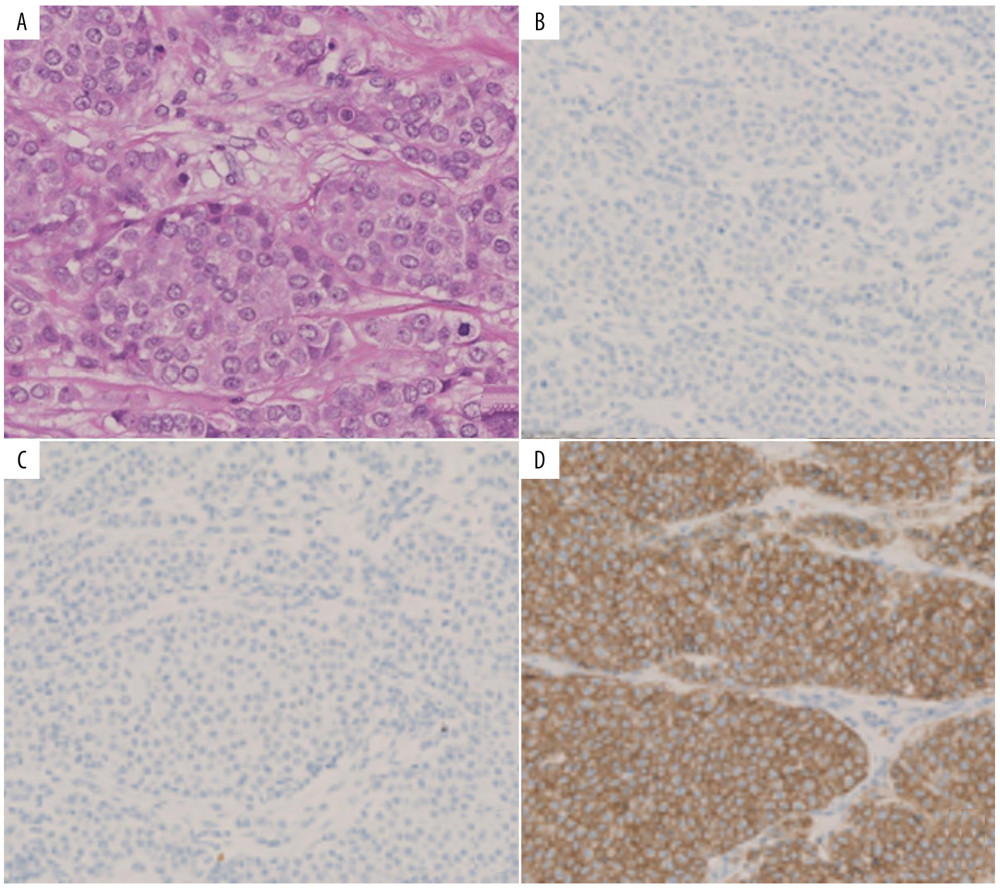 Pathological findings of case 1. The tumor was identified as adenocarcinoma (A). Immunostaining was negative for estrogen receptor (ER) (B) and progesterone receptor (PR) (C), and positive for human epidermal growth factor receptor 2 (HER2) (D).