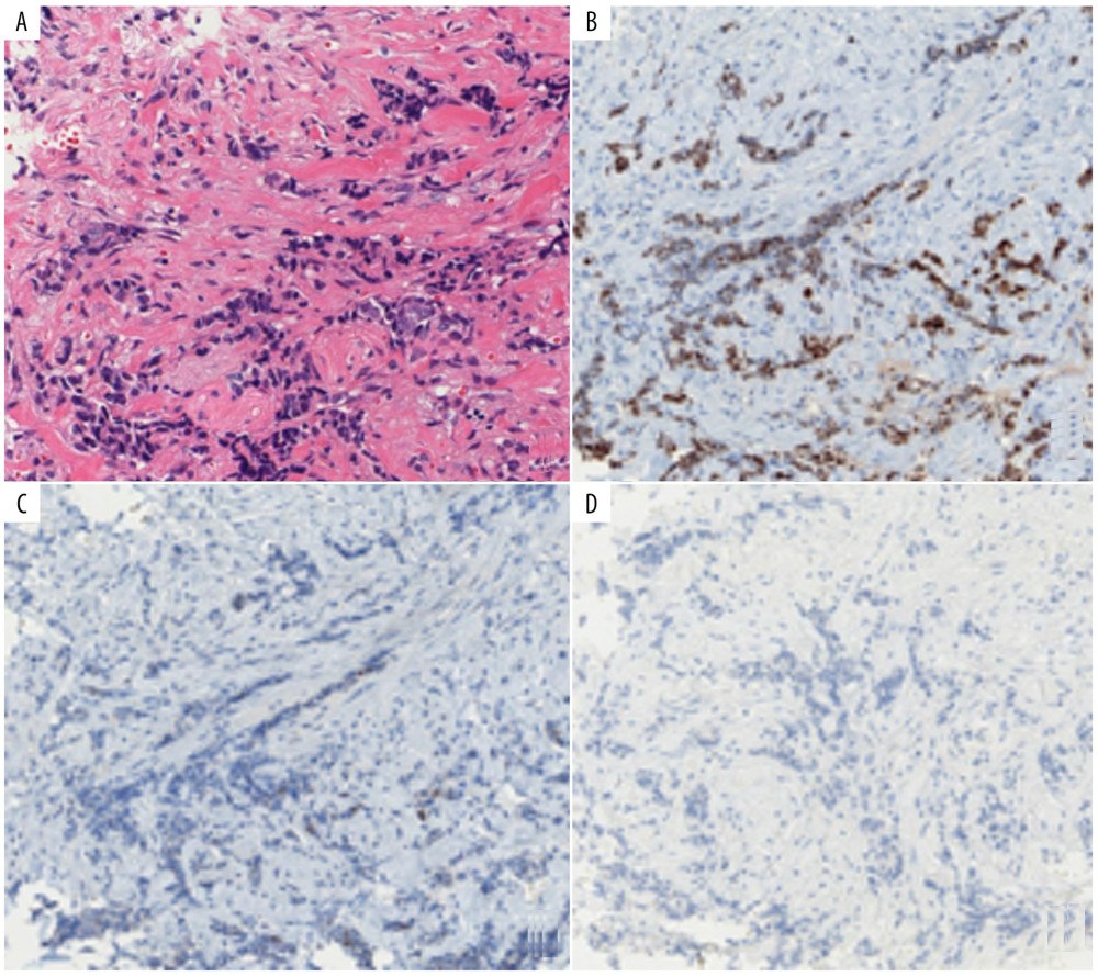 Pathological findings of case 2. The tumor was an adenocarcinoma (A). Immunostaining was positive for estrogen receptor (ER) (B), and negative for progesterone receptor (PR) (C) and human epidermal growth factor receptor 2 (HER2) (D).