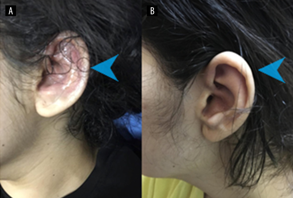(A) Auricular perichondritis involving the cartilaginous portion of the ear (sparing the lobule), before treatment (blue arrow). (B) Improvement in outer ear cartilage during remission (blue arrow).