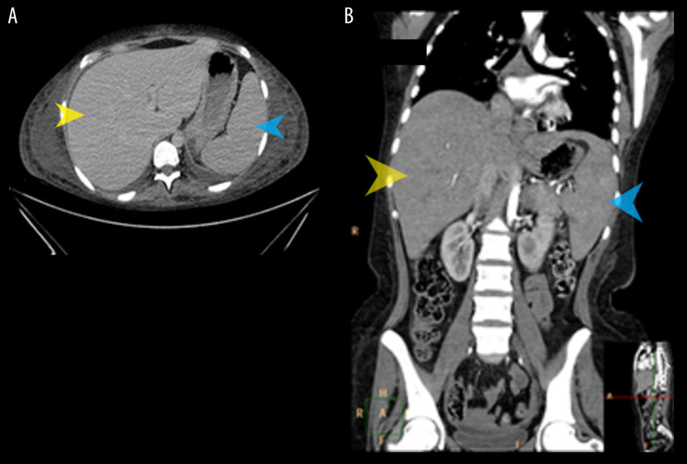 (A) Axial abdominal CT scan showing enlarged spleen (blue arrow) and hepatomegaly (yellow arrow). Spleen measuring 16 cm in long axis with normal echo texture. (B) Coronal abdominal CT preview, showing hepatomegaly (yellow arrow) and splenomegaly (blue arrow).